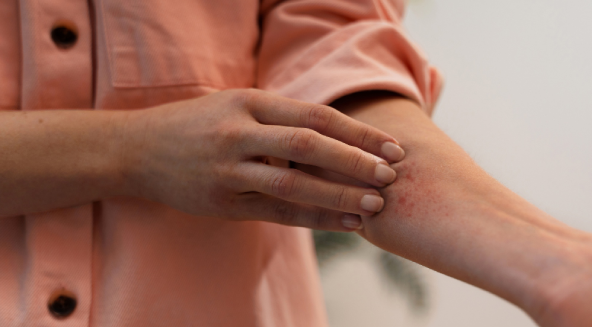 Atopik Dermatit Nedir? Nasıl Anlaşılır?