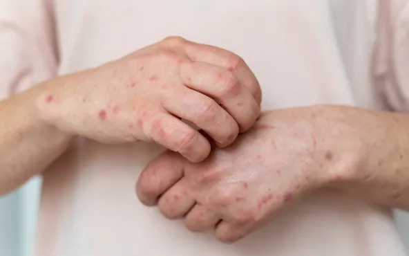 What is Monkeypox Virus?