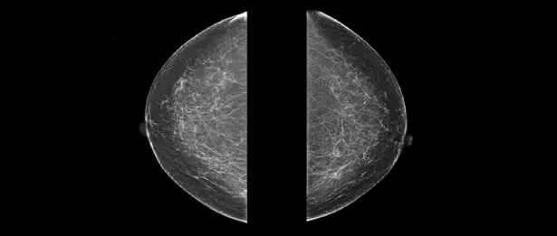 What is Breast Biopsy?