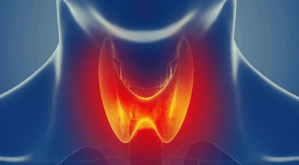 Curiosités sur le cancer de la thyroïde et le traitement par iode radioactif 